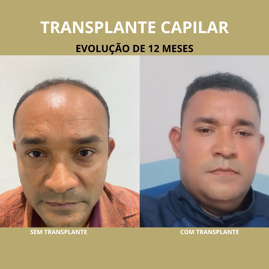 TRANSPLANTE EM SOBRANCELHA (1)