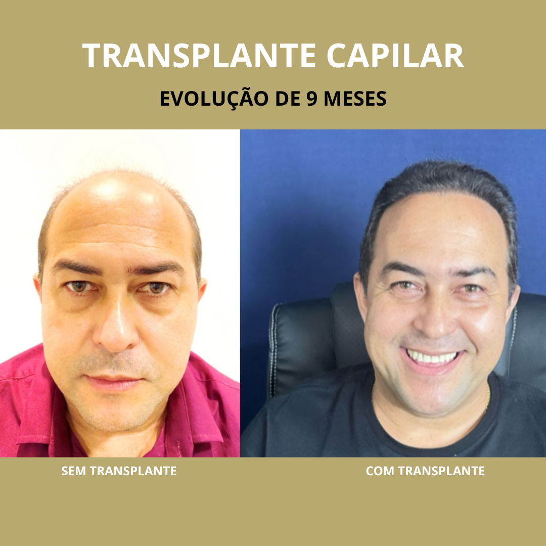 TRANSPLANTE EM SOBRANCELHA (2)