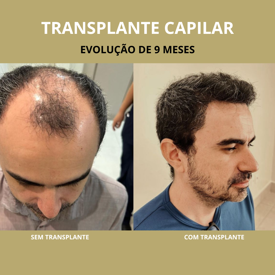 TRANSPLANTE EM SOBRANCELHA (4)